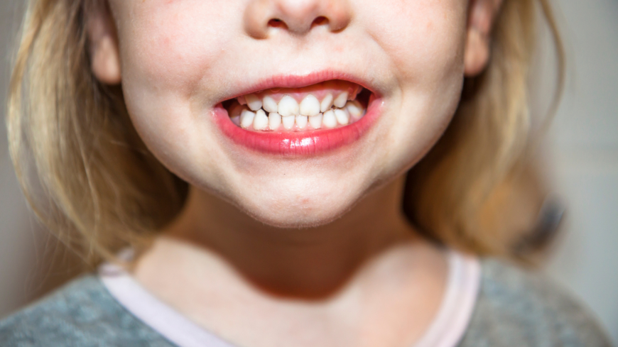 Förutom att karies ökar så ser man också att av tandhälsan förvärras hos de 30 procent av alla barn som redan har sämst tandhälsa.  Foto: Shutterstock